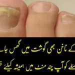 Nail-Fungus-Treatment-at-Home-in-Urdu