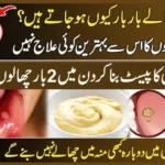 How-to-Get-Rid-of-Canker-Sores-with-Natural-Home-Remedies